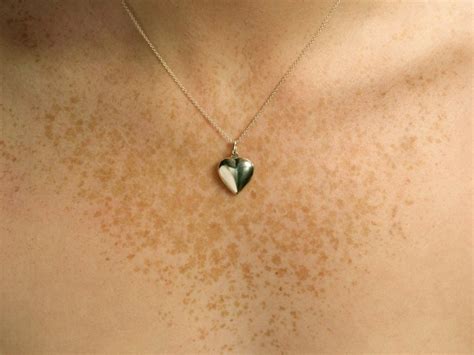 freckles boobs|This Woman’s Chest ‘Freckles’ Were a Rare Sign of Breast Cancer